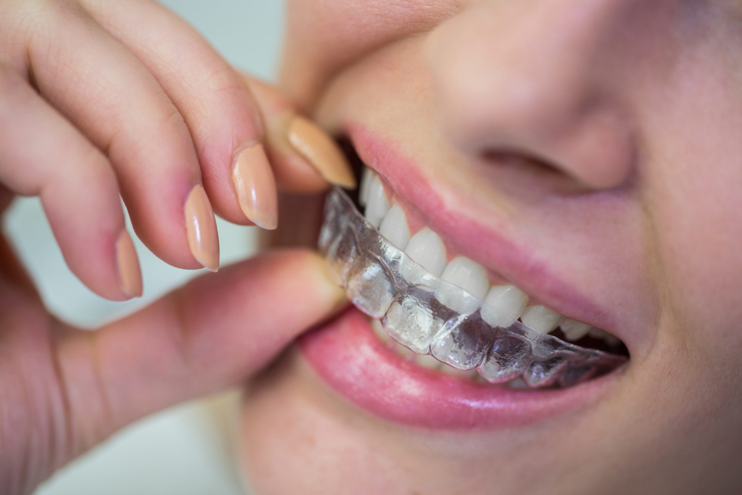 Can Invisalign Make Your Smile Wider and Bigger?